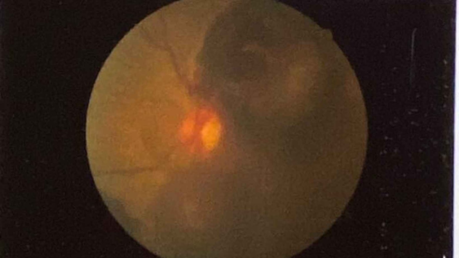 Família de São Gotardo cria vaquinha para cirurgia urgente da avó com hemorragia retiniana