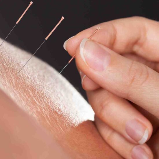 Acupuntura: Uma Abordagem Tradicional para a Saúde Integral