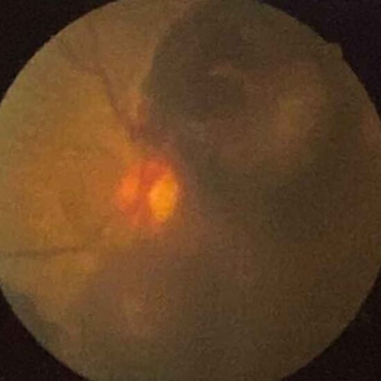 Família de São Gotardo cria vaquinha para cirurgia urgente da avó com hemorragia retiniana